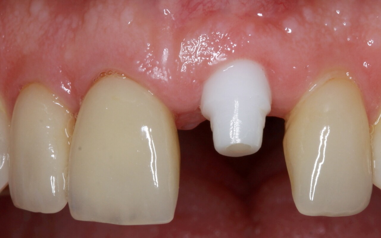 Ceramic implant