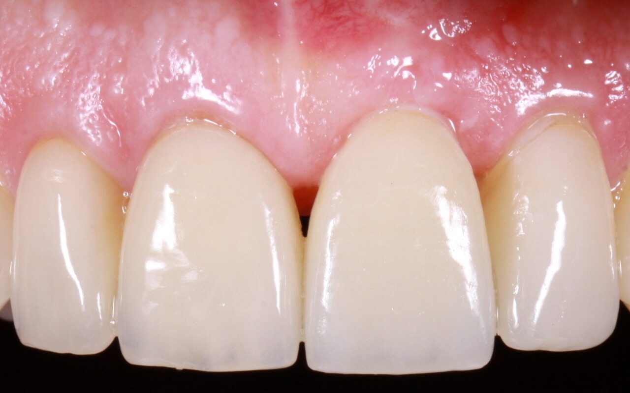 Ceramic implant