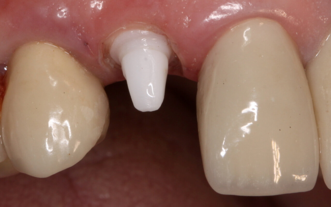 Ceramic implant