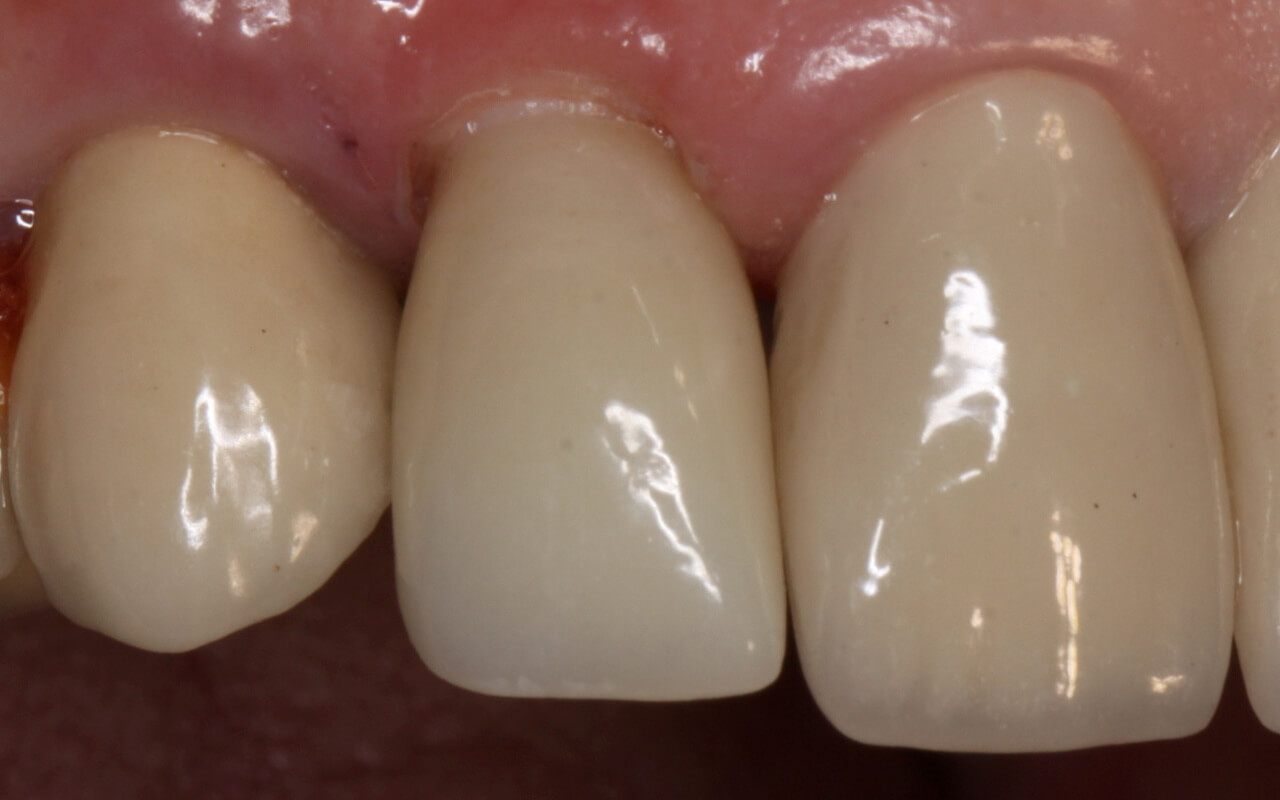 Ceramic implant