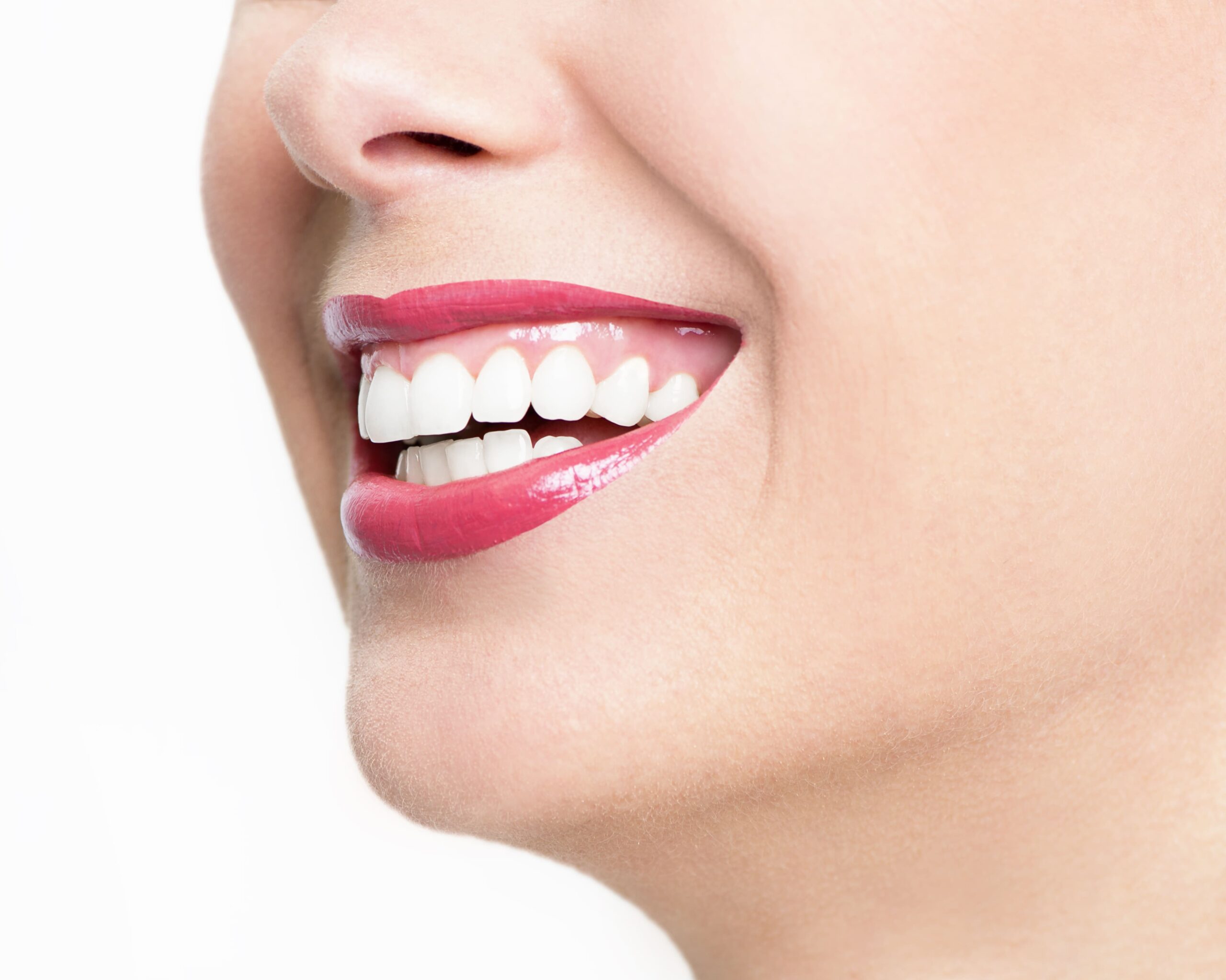 bleaching Bleaching Wien - Smile Lounge