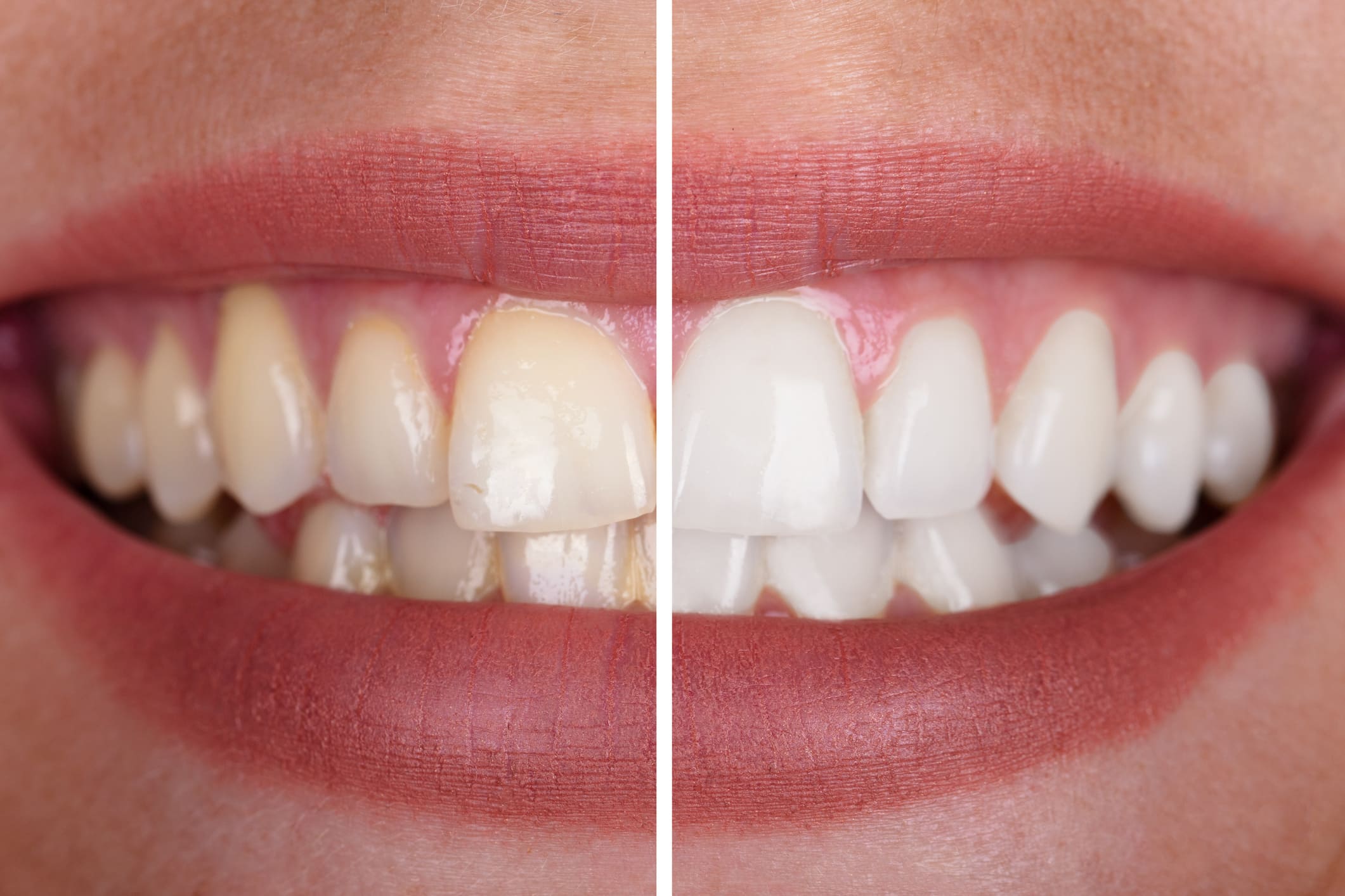 Smile Makeover für ästhetisch ansprechende Zähne
